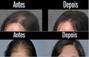 minoxidil