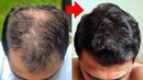minoxidil