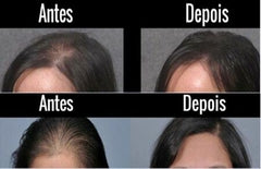 minoxidil