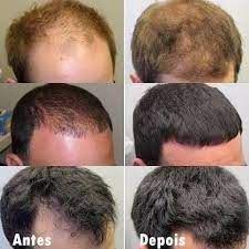 minoxidil