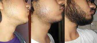 minoxidil