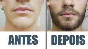 minoxidil